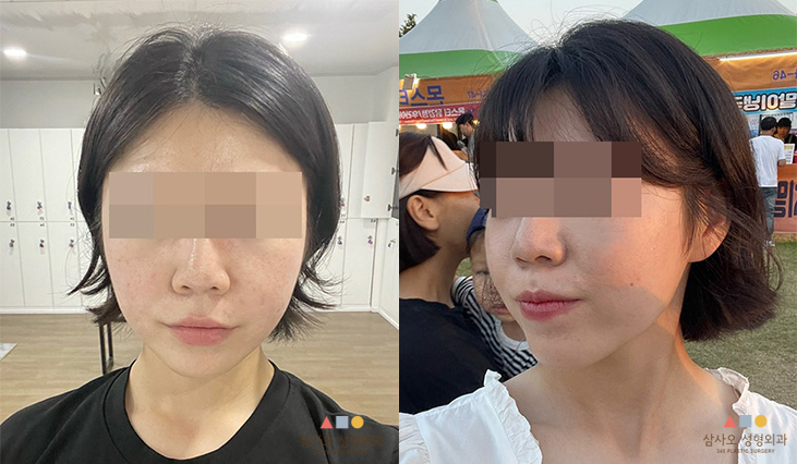 수술 후