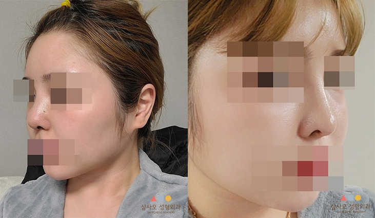 수술 후