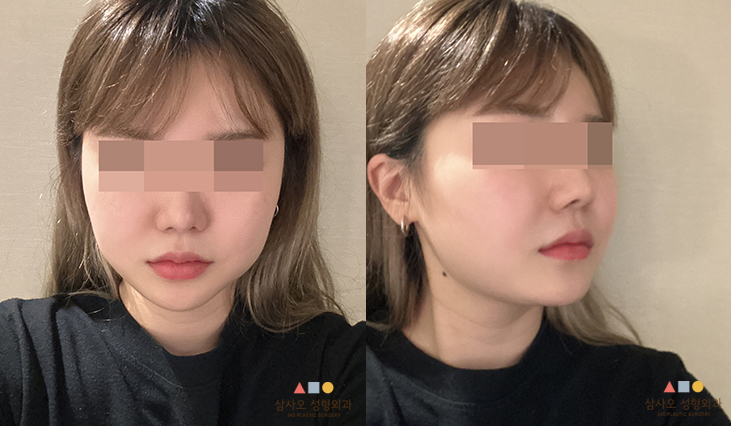 수술 후