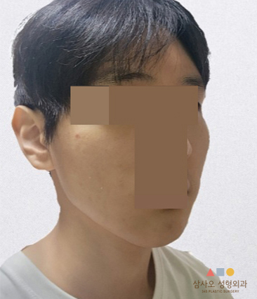 수술 전