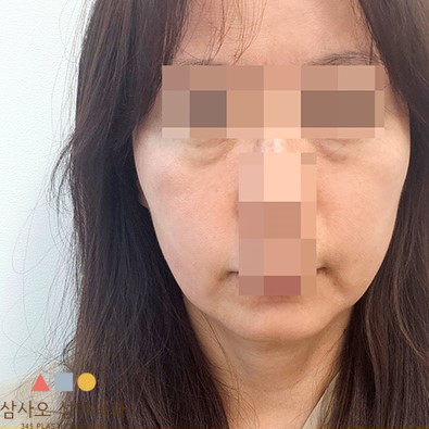수술 전