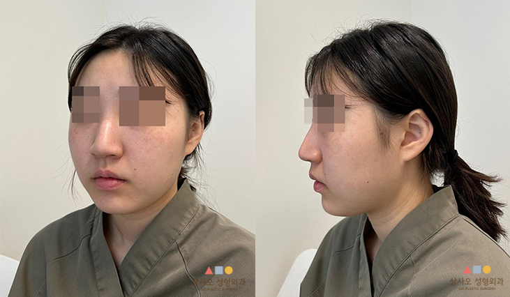 수술 전
