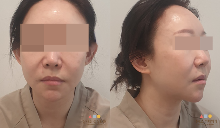 수술 전