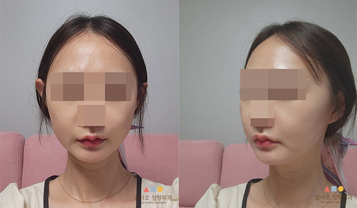 수술 후