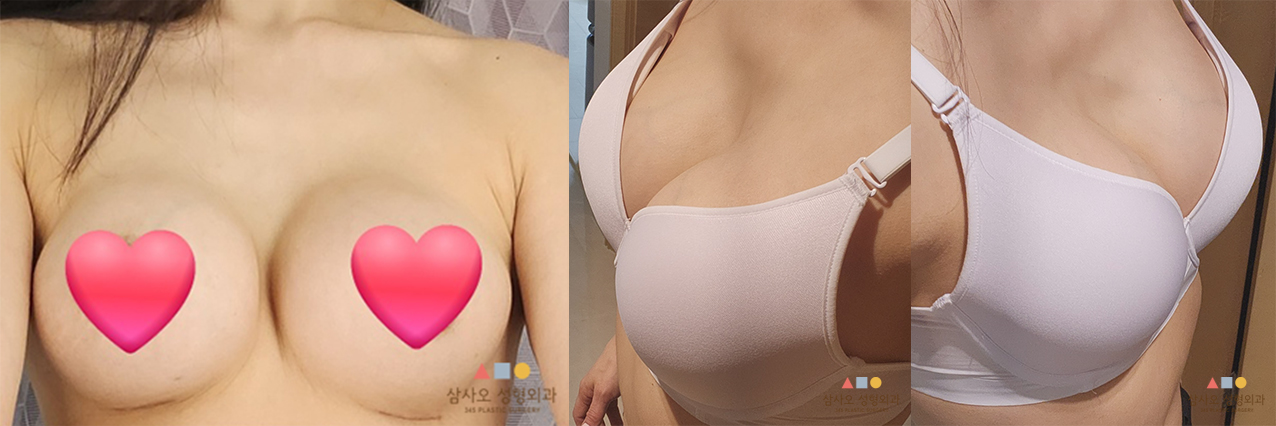 수술 후