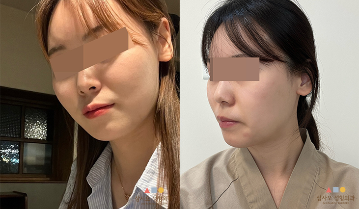 수술 전