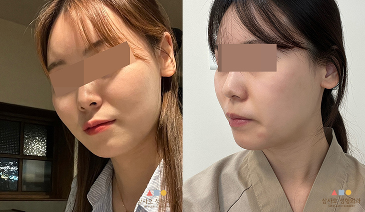 수술 전