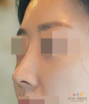수술 후