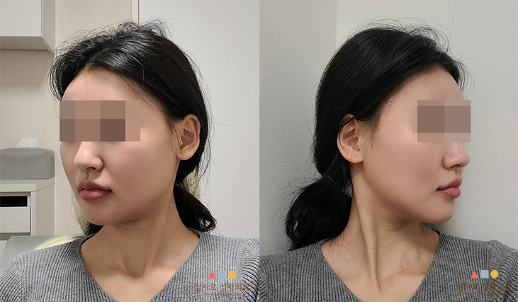 수술 후