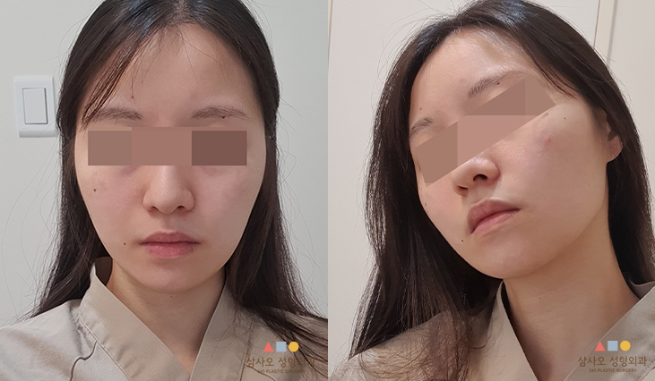 수술 전