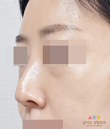 수술 전