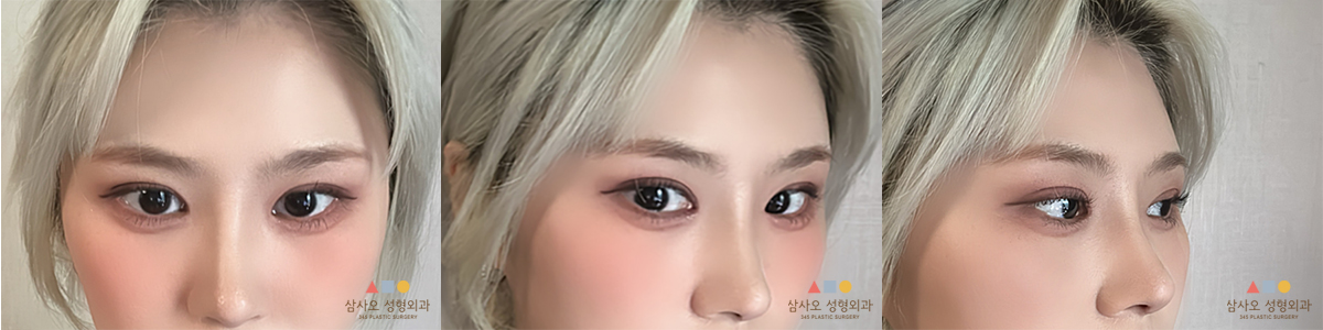 수술 후