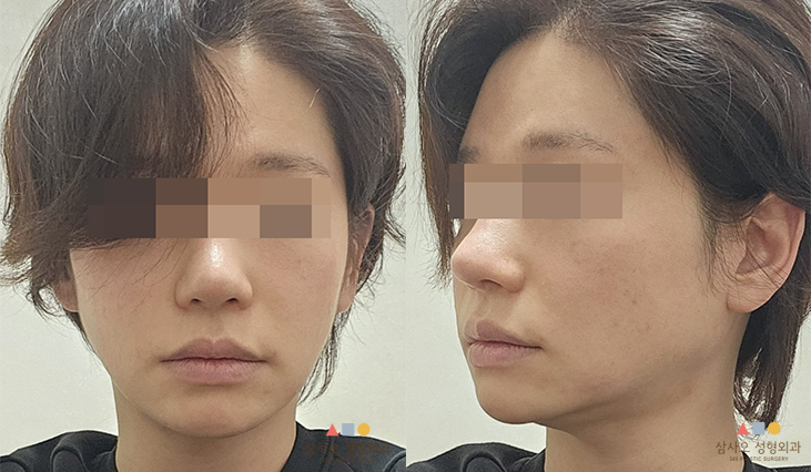 수술 전