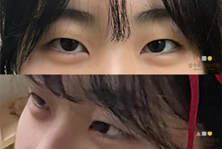 수술 전