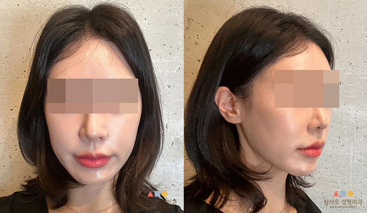 수술 후