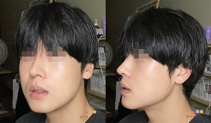 수술 후