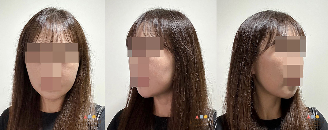수술 후