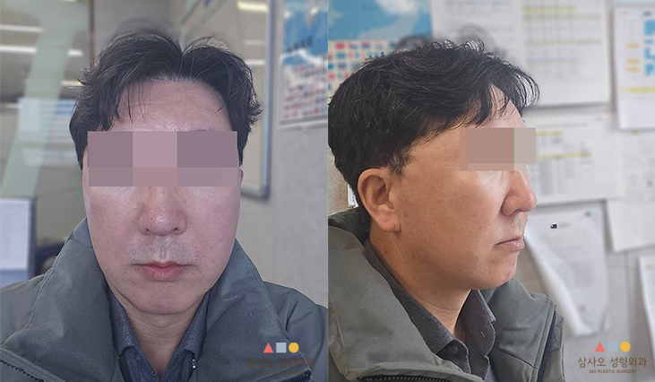수술 후