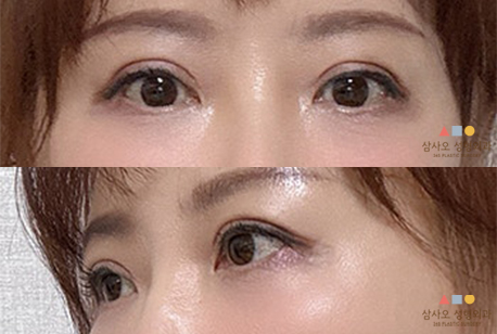수술 후