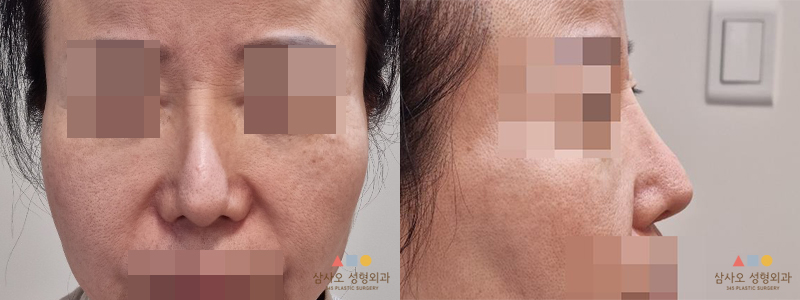 수술 전