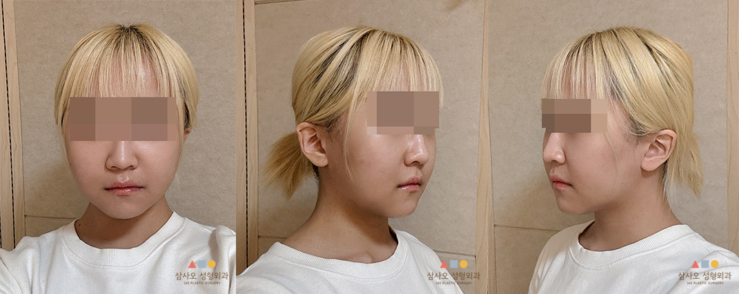 수술 후