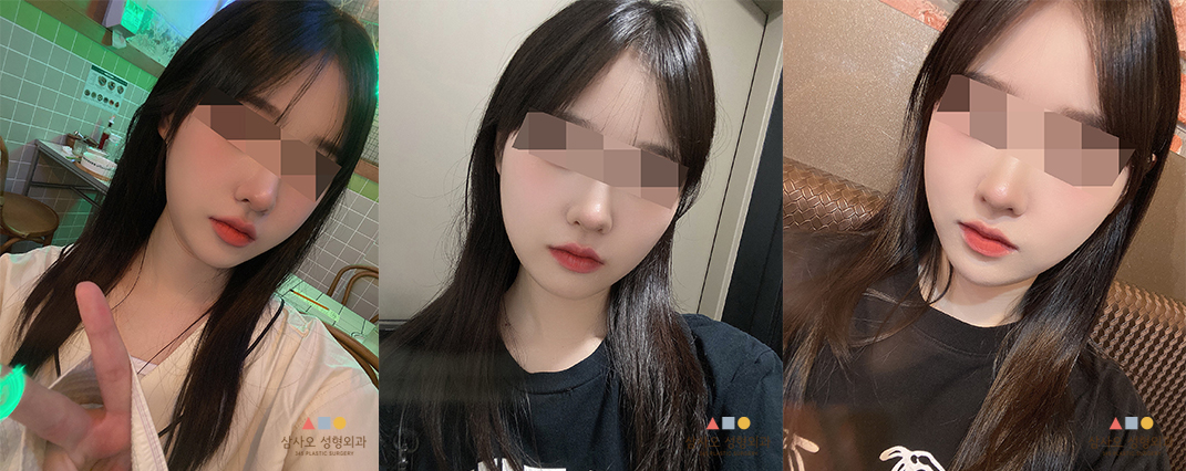 수술 후
