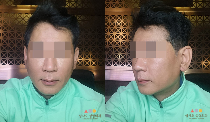 수술 후