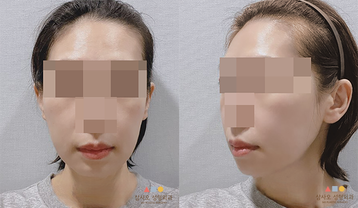 수술 후