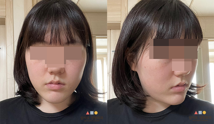 수술 전