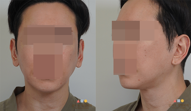 수술 전