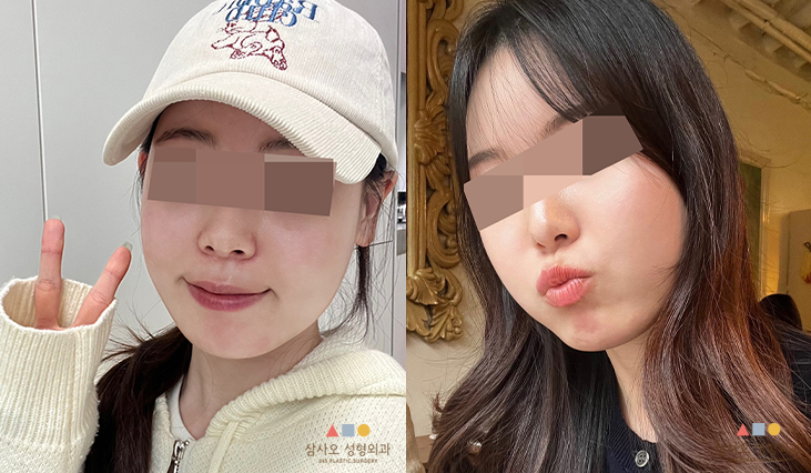 수술 후