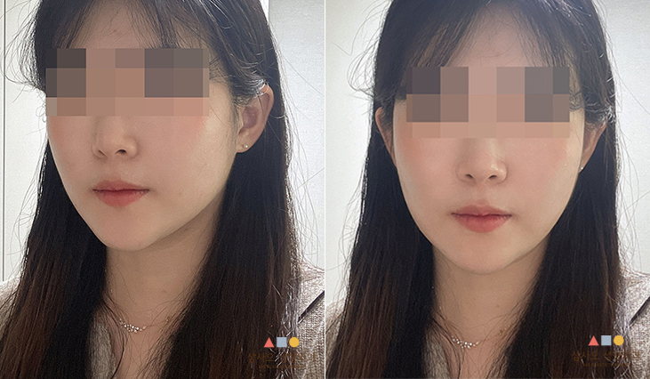 수술 후