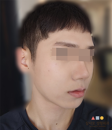 수술 후