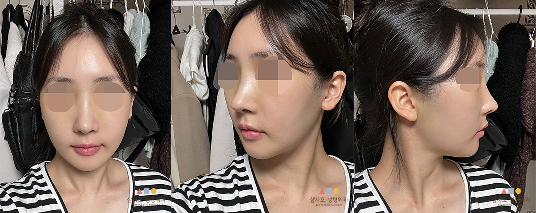 수술 후
