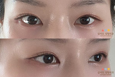 수술 후