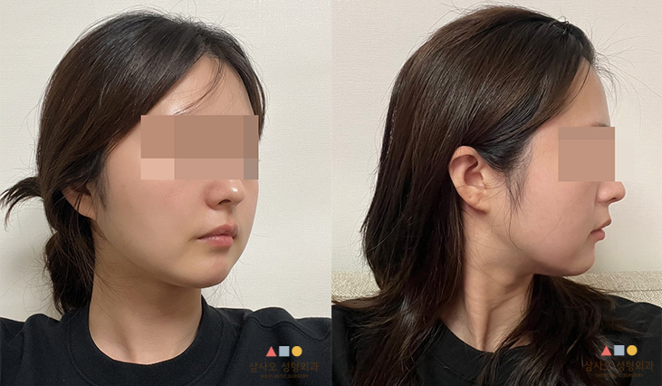 수술 후