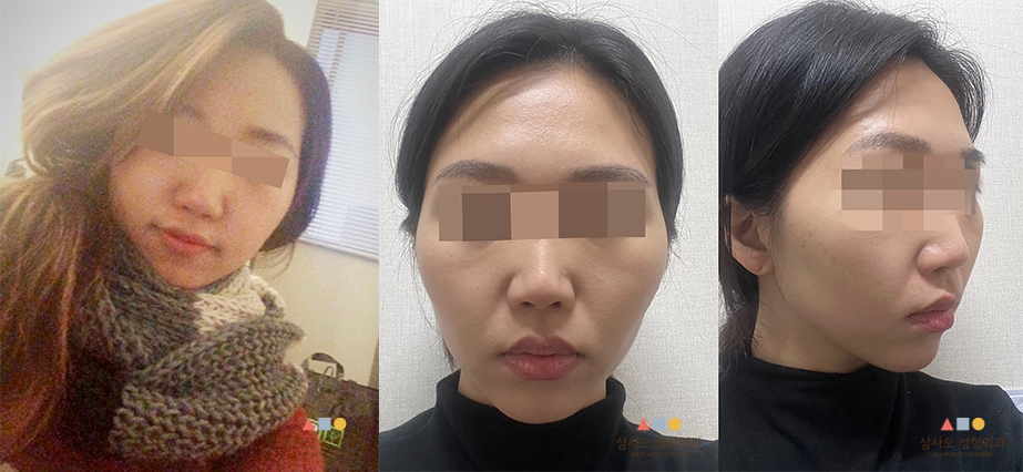 수술 전