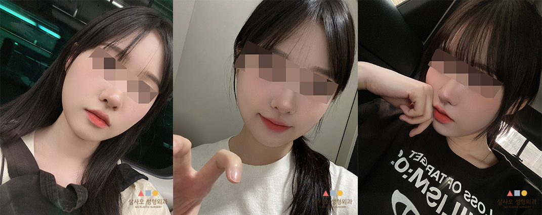 수술 후