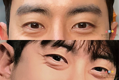 수술 전