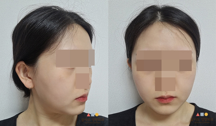 수술 후