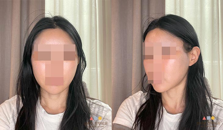 수술 후