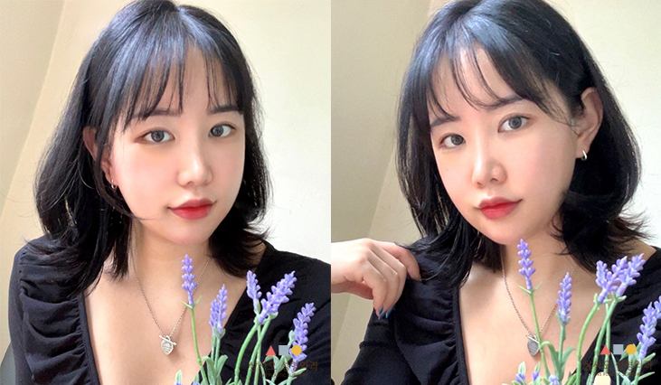 수술 후