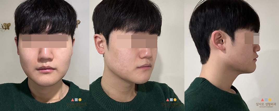 수술 후