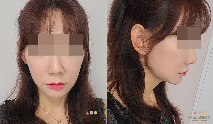 수술 후