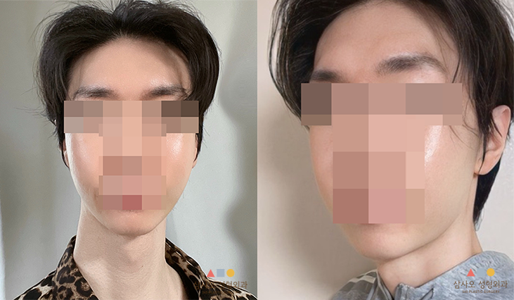 수술 후