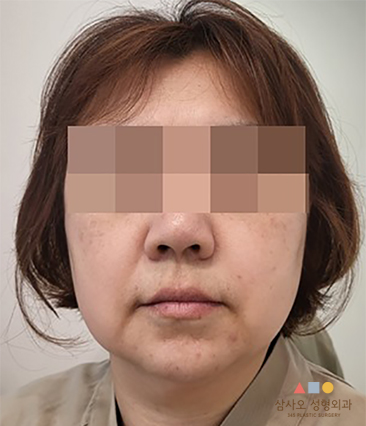 수술 전