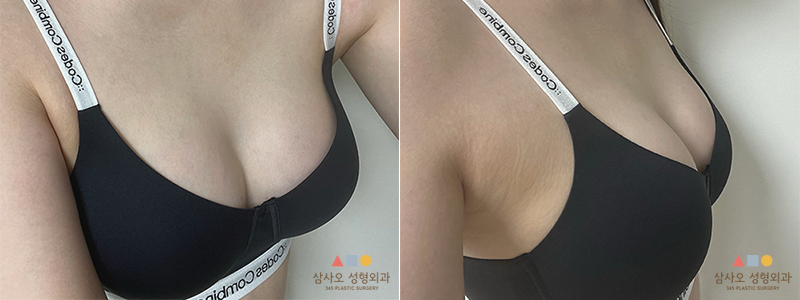 수술 후