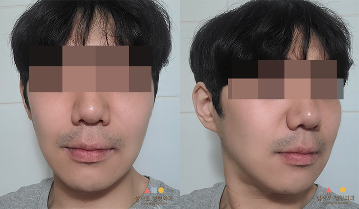 수술 후