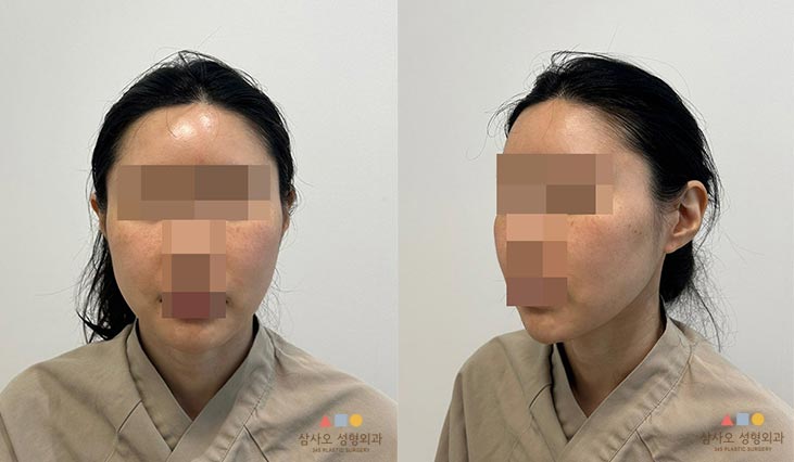 수술 전
