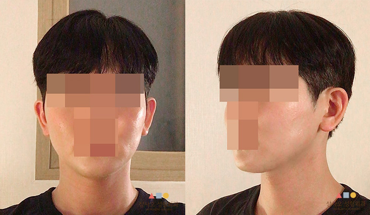 수술 후